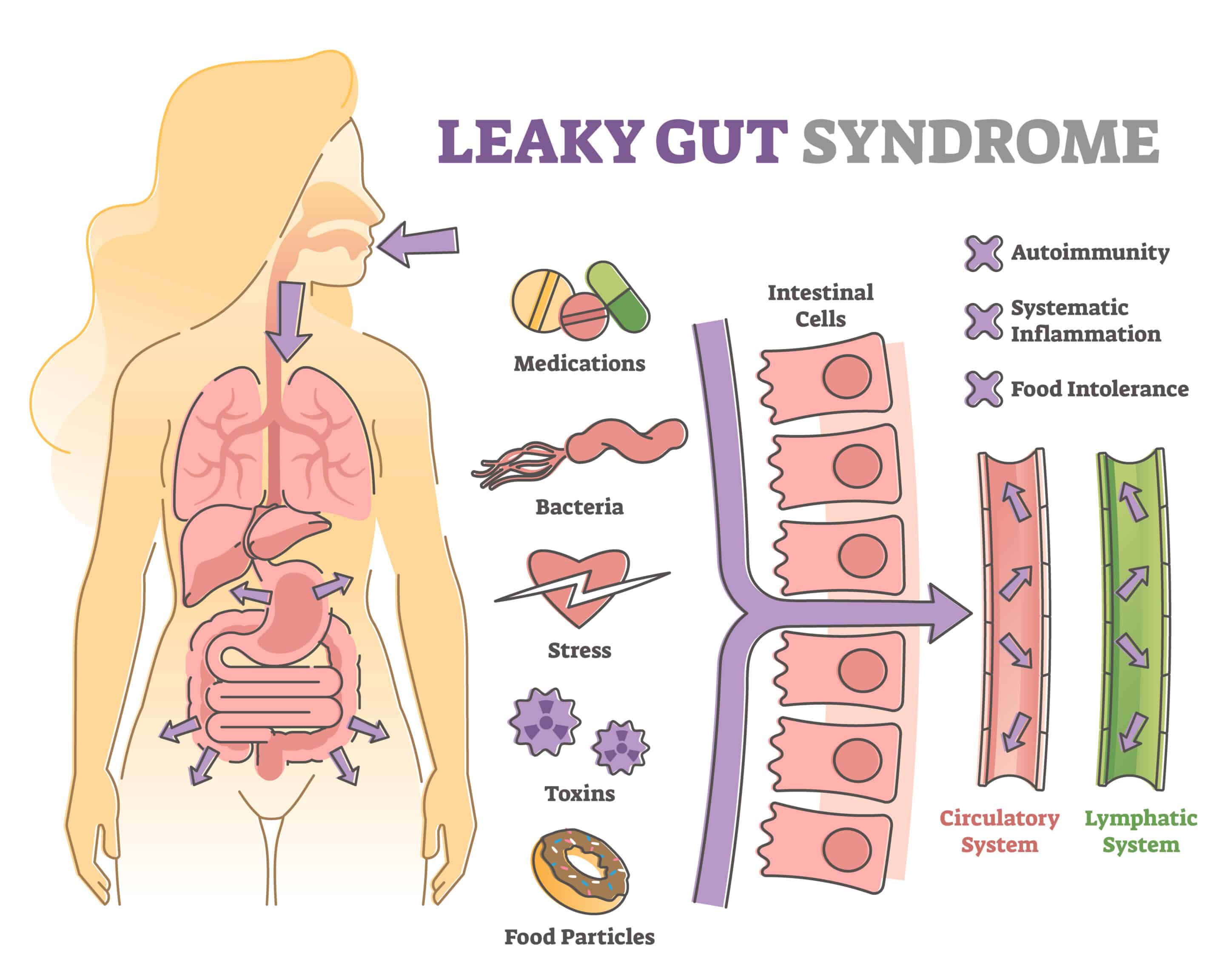 Leaky gut syndrome as immune system reaction to environment outline diagram. Educational labeled scheme with autoimmunity and inflammation causes from gastrointestinal problems vector illustration.